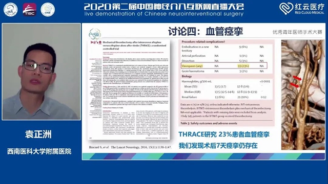 西南醫(yī)大附院腦卒中團(tuán)隊(duì)袁正洲博士再次斬獲全國(guó)冠軍！