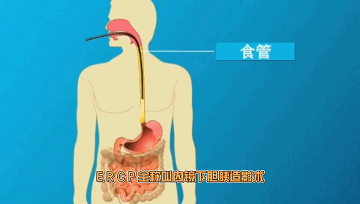 傷口又小恢復(fù)又快，膽管結(jié)石“殺手”來了！
