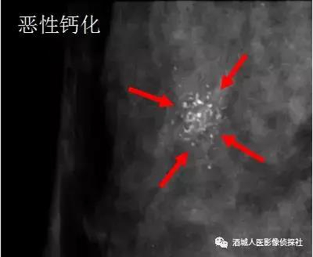 鉬靶、超聲、磁共振...篩查早期乳腺癌到底該選啥？(圖2)