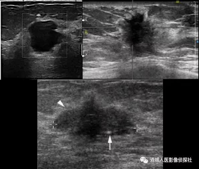 鉬靶、超聲、磁共振...篩查早期乳腺癌到底該選啥？(圖3)