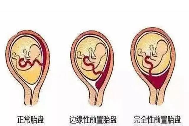驚心動(dòng)魄，相遇而安！38歲產(chǎn)婦的好“孕”人生(圖3)