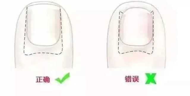 【擴(kuò)散】指甲剪太短！代價可不只是痛和流血……(圖6)