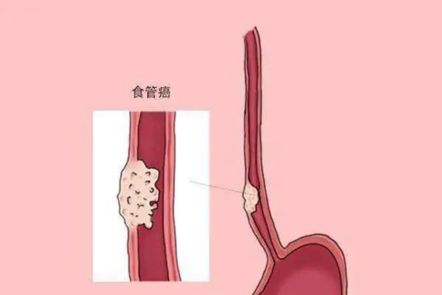【警惕】大爺吃東西覺得哽，一查竟是癌！(圖7)