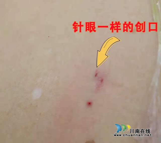 合江縣中醫(yī)醫(yī)院手術(shù)設(shè)備再添利器，針眼開(kāi)口取石不留疤痕！(圖2)