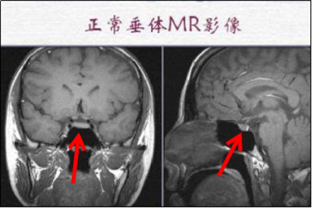 【擴散】孩子長太高？警惕腦子出問題！(圖3)
