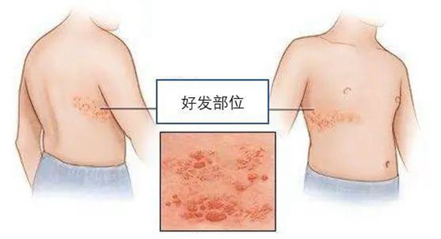 “蛇纏腰”可通過(guò)打疫苗預(yù)防，趕緊帶父母去打(圖3)