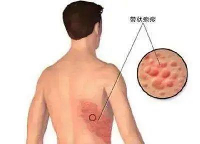 “蛇纏腰”可通過(guò)打疫苗預(yù)防，趕緊帶父母去打(圖4)