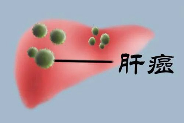 【擴(kuò)散】肝癌患者注意，西南醫(yī)大中醫(yī)院可免費(fèi)治療！(圖2)
