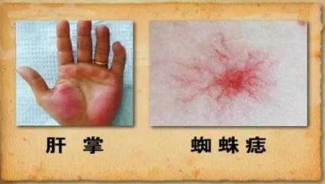 【擴(kuò)散】肝癌患者注意，西南醫(yī)大中醫(yī)院可免費(fèi)治療！(圖7)
