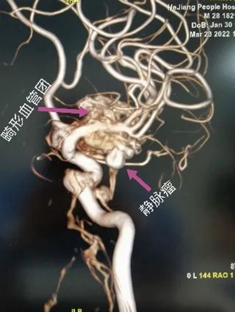 西南醫(yī)大附院“拆彈專家”黃昌仁：數(shù)小時(shí)成功拆除28歲小伙腦中的“不定時(shí)炸彈”(圖2)