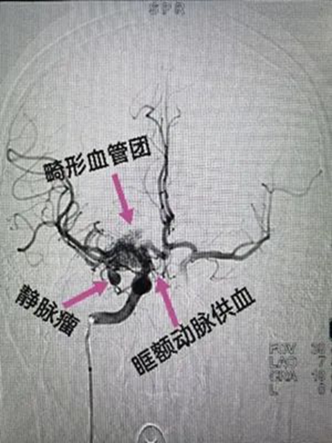 西南醫(yī)大附院“拆彈專家”黃昌仁：數(shù)小時(shí)成功拆除28歲小伙腦中的“不定時(shí)炸彈”(圖3)