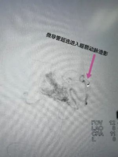 西南醫(yī)大附院“拆彈專家”黃昌仁：數(shù)小時(shí)成功拆除28歲小伙腦中的“不定時(shí)炸彈”(圖4)
