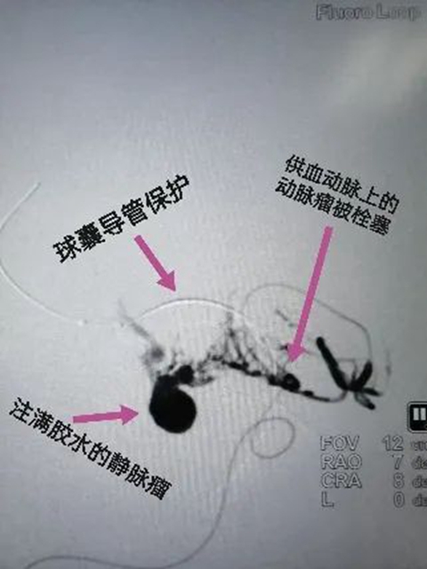 西南醫(yī)大附院“拆彈專家”黃昌仁：數(shù)小時(shí)成功拆除28歲小伙腦中的“不定時(shí)炸彈”(圖5)