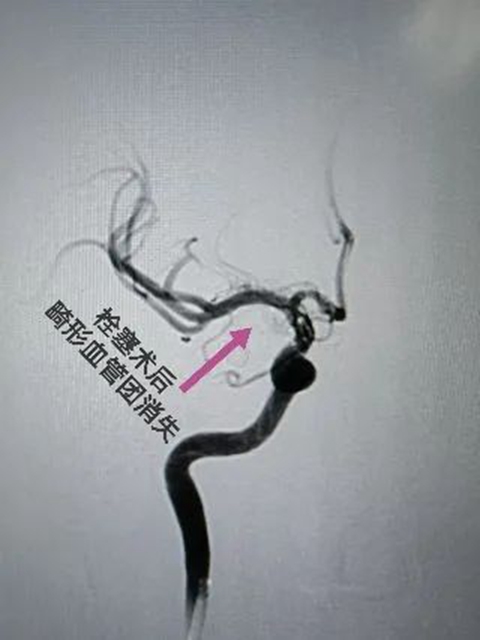 西南醫(yī)大附院“拆彈專家”黃昌仁：數(shù)小時(shí)成功拆除28歲小伙腦中的“不定時(shí)炸彈”(圖6)