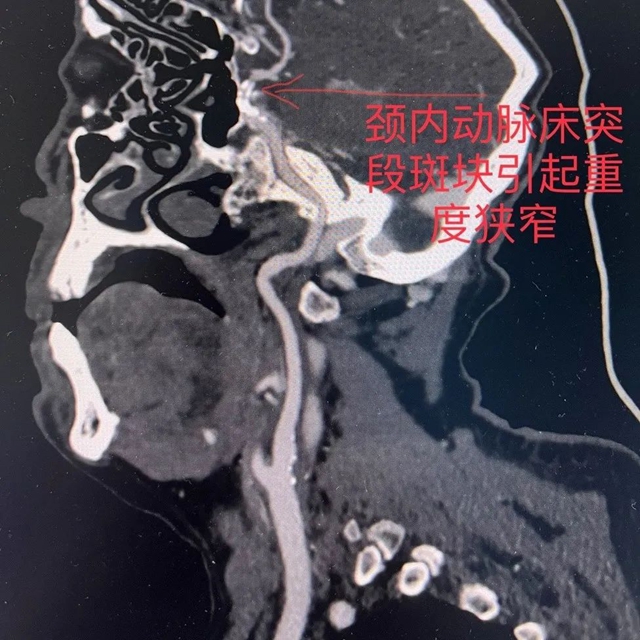 83歲大爺突發(fā)腦梗，市人醫(yī)團(tuán)隊(duì)緊急施救挽回生命