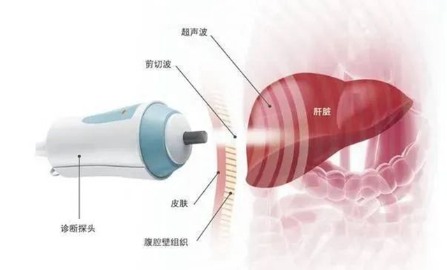 您的肝還好嗎？教您一分鐘看懂您的“肝彈性檢查報(bào)告”