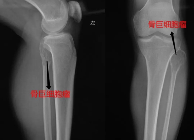 【罕見】瀘州36歲男子小腿變粗長包，結(jié)果竟是……