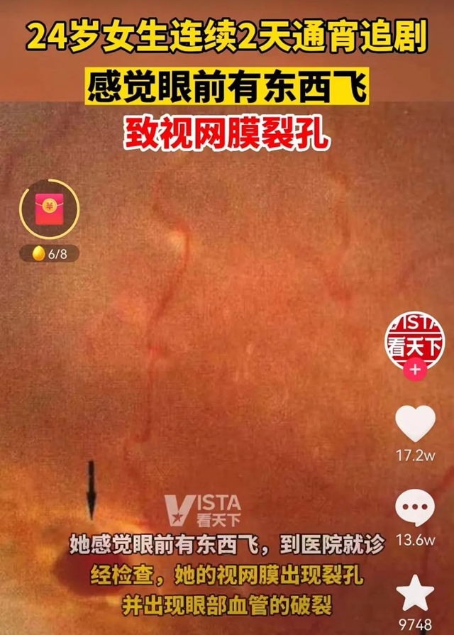 【警惕】通宵追劇，24歲女子差點瞎了