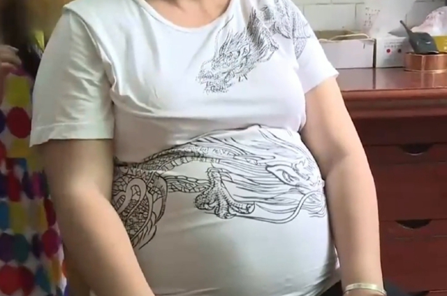 【罕見】女子肚大如10月孕婦，竟是……