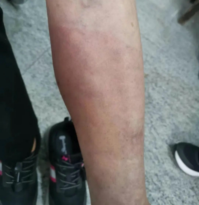 【警惕】又一批人因?yàn)榕菽_進(jìn)了醫(yī)院，這4種人真的不適合泡腳！