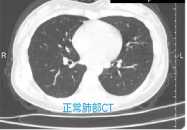 懷疑自己患上“白肺”？先看看這些才知道！