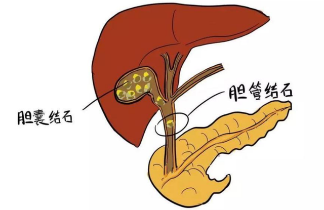 【圍觀】一頓火鍋后，瀘州孃孃要切膽囊？