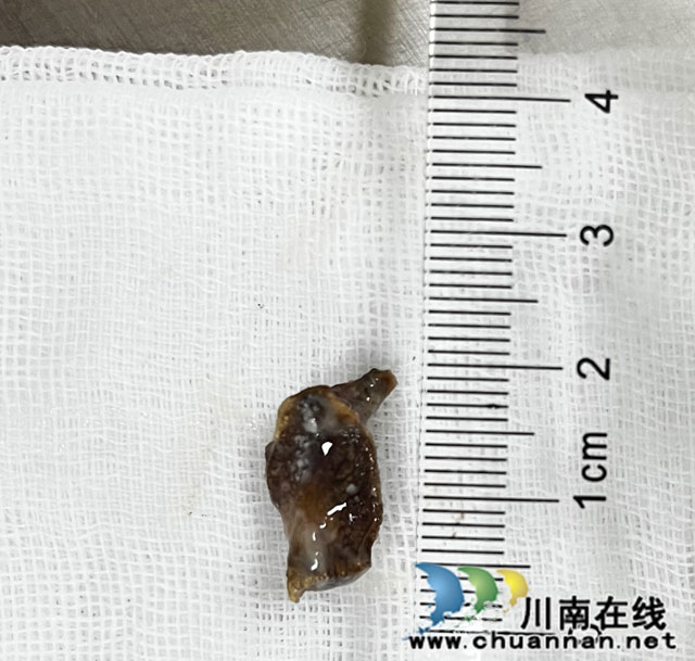 【圍觀】骨頭卡氣管，一年后才發(fā)現(xiàn)……