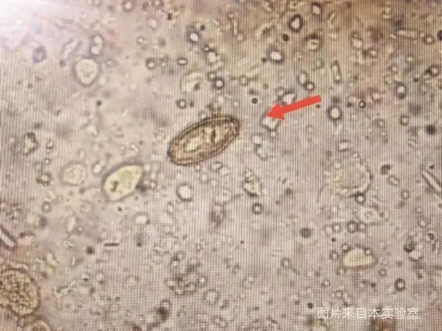 【警惕】連續(xù)幾天查出肝吸蟲卵，醫(yī)生提醒：這種食物少吃！