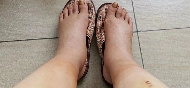 全身一按一個坑，很多人都忽略了這個病……