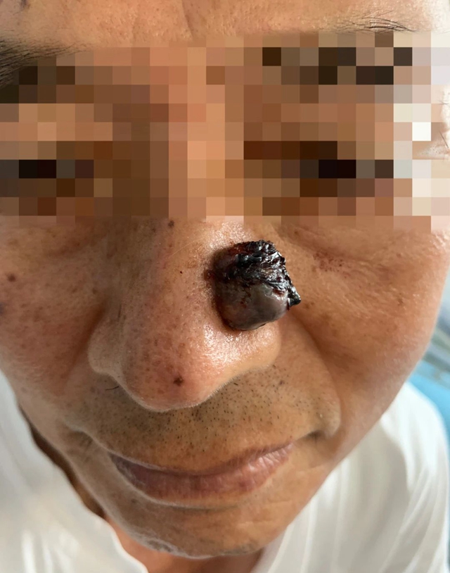 【圍觀】鼻子上的一顆痘，竟長(zhǎng)成癌中之王