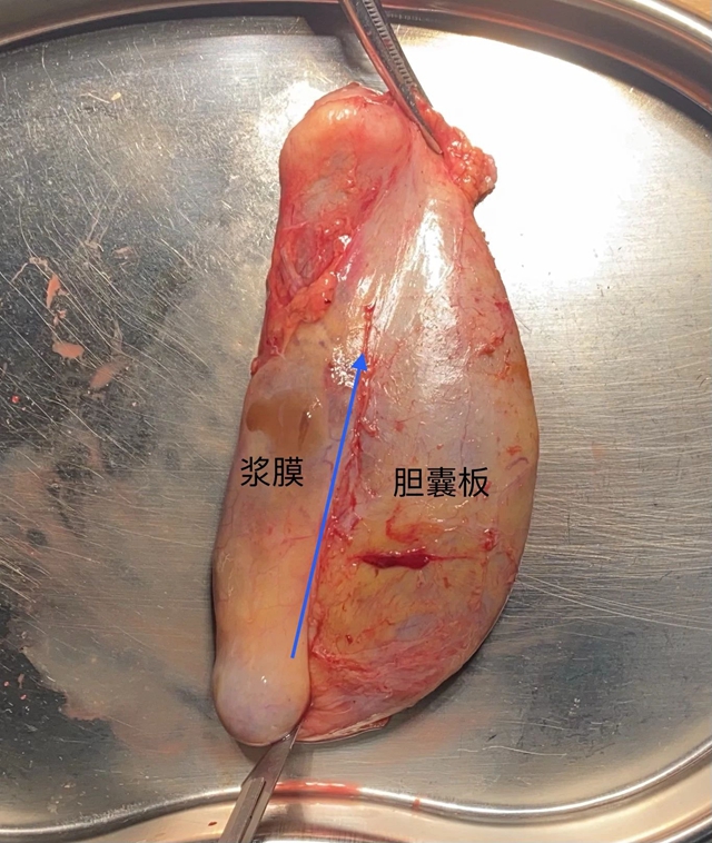 【當心】息肉癌變！專家提醒：這樣的要及時切