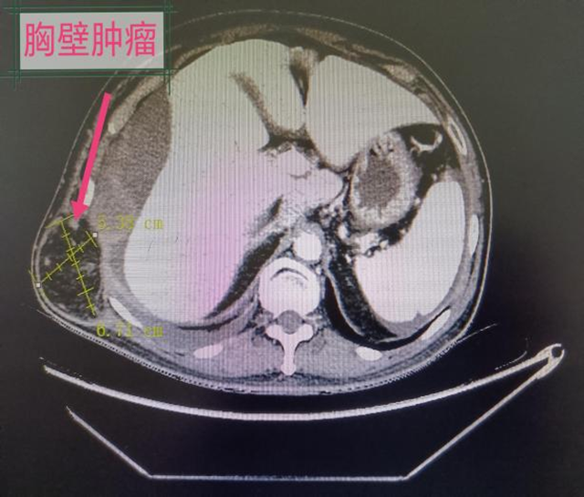 9個(gè)科室的專家集體出動(dòng)，為他取出滿滿一盆腫瘤...