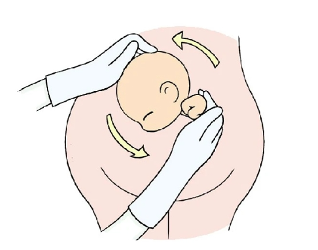 【厲害】又一例！僅一分鐘，醫(yī)生徒手扭轉(zhuǎn)胎位不正