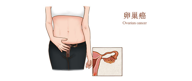 【擴(kuò)散】婦科第一癌，發(fā)現(xiàn)多晚期，出現(xiàn)這5個(gè)癥狀，一定要注意