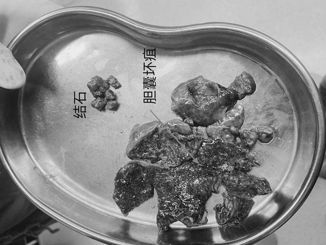 【擴(kuò)散】一頓牛油火鍋，瀘州嬢嬢膽囊遭戳脫！
