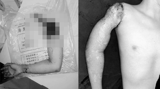 【驚險】19歲男子手臂被絞斷，流血不止.......