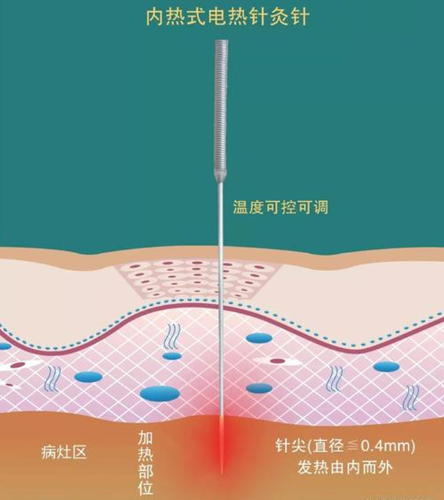 【新技術】中醫(yī)“手術刀”——內(nèi)熱針技術
