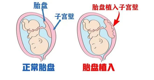 【兇險(xiǎn)】罕見的熊貓血孕婦，出血“一灘”......