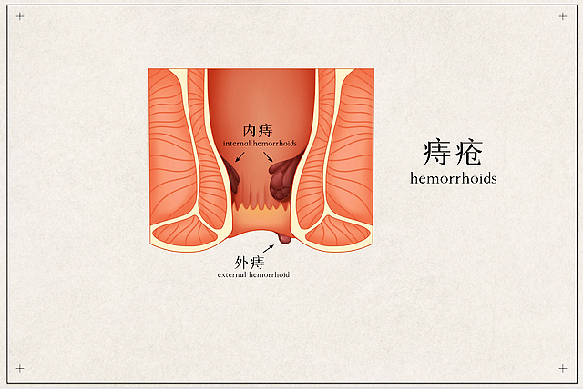 【提醒】錯(cuò)把腸癌當(dāng)痔瘡，耽誤了多少性命！大便出現(xiàn)這3個(gè)變化，要懷疑腸癌的可能