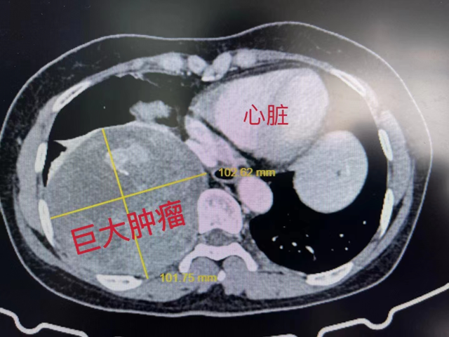 【圍觀】直徑超13厘米，女子長出巨大腫瘤！