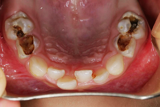 【關(guān)注】牙齒爛完了都不敢拔，小娃兒滿口都是黑洞洞