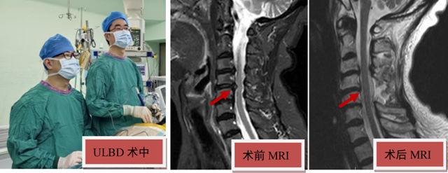 僅開直徑不足1厘米小孔做手術(shù)，就解決了75歲婆婆常年手臂疼痛困擾……