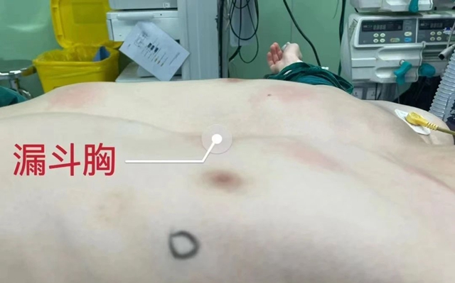 【圍觀】年僅20歲，胸卻塌了！
