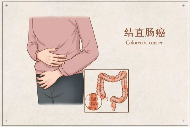 【擴散】30歲瀘州小伙患腸癌，大便這些情況，需注意......