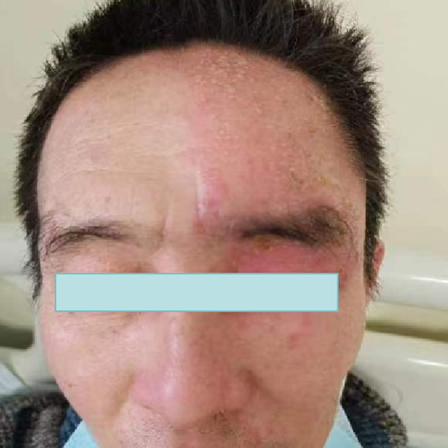【關(guān)注】可怕的“蛇纏腰”，纏滿一圈就會死人嗎？