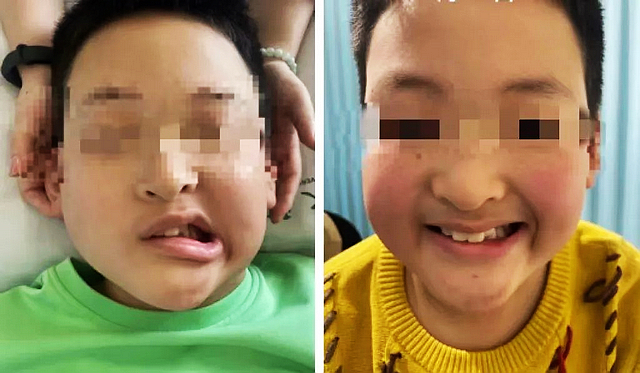 【警惕】10歲小孩面癱！