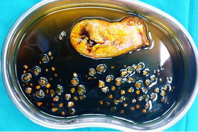 【關(guān)注】大魚大肉的生活，肖女士膽囊遭嘎掉！