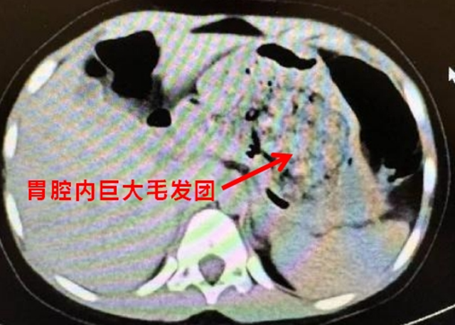 【圍觀】5歲女孩確診“長發(fā)公主綜合征”？多地已有病例，醫(yī)生提醒