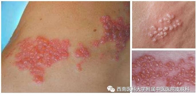 【擴(kuò)散】這個(gè)病，死不了但折磨人！這4類人要當(dāng)心