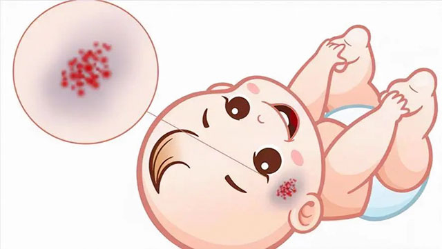 【警惕】7個(gè)月寶寶，面部長(zhǎng)出血管瘤！